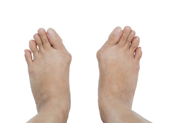 Hallux Valgus Monturi Newsmed Ro