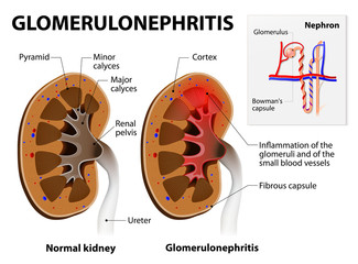 dureri articulare glomerulonefrite durere la nivelul coloanei vertebrale și forului articulațiilor