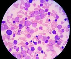 Leucemia Acută Limfoblastică La Copil Newsmed Ro