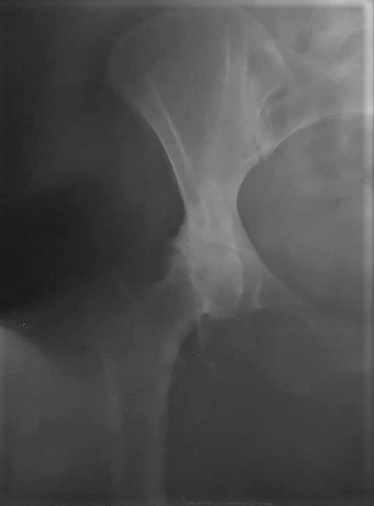 artroza deformantă a coxartrozei articulației șoldului