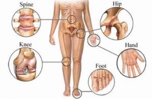 articulațiile degetelor doare și amorțite Este posibil să dansezi cu artrita articulației genunchiului