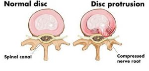 Simptome ale herniei de disc cervicale