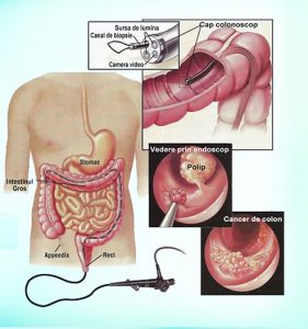 Bolile inflamatorii intestinale: cauze, simptome, tratament