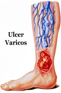 vindecarea ulcerului în varicoza
