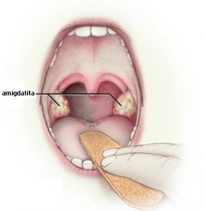 Dureri articulare și amigdalectomie. Reumatismul articular acut (febra reumatică)