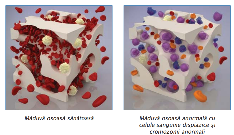 Sindroamele Mielodisplazice Diagnostic I Tratament Newsmed Ro