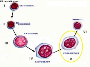 Leucemia limfocitara cronica (LLC) - simptome si tratament - Cancer