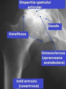 Diagnosticul de deformare a artrozei șoldului