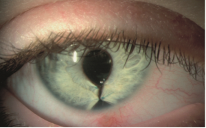 Coloboma irisului, cristalinului, și un ochi foto-lea, cauze si tratament, Coloboma vedere ochilor