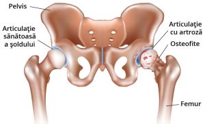 tratamentul ulcerului articular artroza deformantă a articulației umărului și tratamentul acesteia
