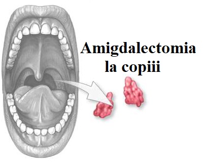 dureri articulare și amigdalectomie)