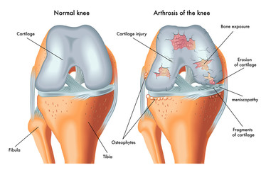 artroza semnelor articulațiilor lombare intervertebrale